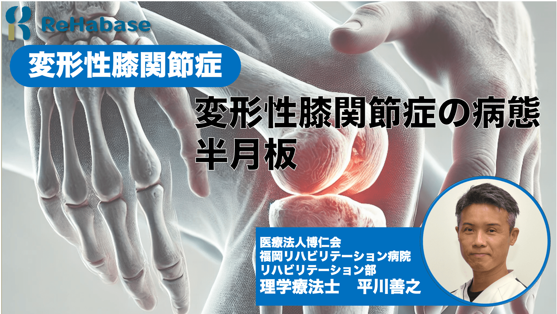 変形性膝関節症の病態:半月板